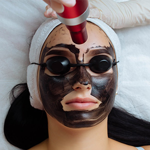 laserowy peeling węglowy